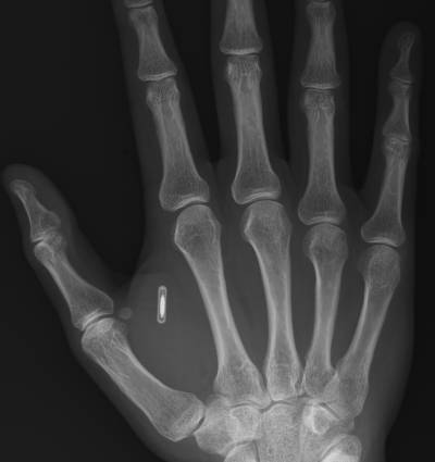 Avertizarea experţilor: Se va întâmpla cu toată lumea. Fiecare va primi un implant cu microcip până la urmă