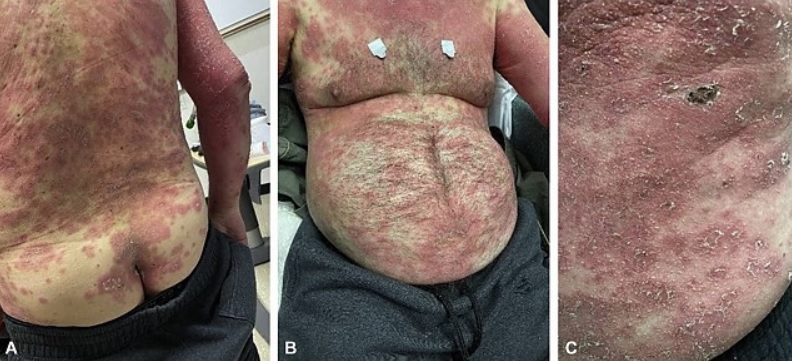Au apărut „solzii de pește” de după vaccin. FOTO, VIDEO și STUDIU al Centrului Național de Informații privind Biotehnologia al Statelor Unite ale Americii. Părintele Zenovie de la Mănăstirea Nechit a avut dreptate