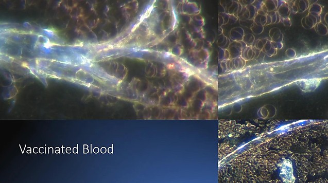 Structuri mecanice ciudate în vaccinuri: „arată ca niște circuite și microcipuri”. Doctorița Ana-Maria Mihalcea din SUA face noi descoperiri stranii: ARNm trunchiat sau inexistent în fiolele de vaccin Covid-19. FOTO
